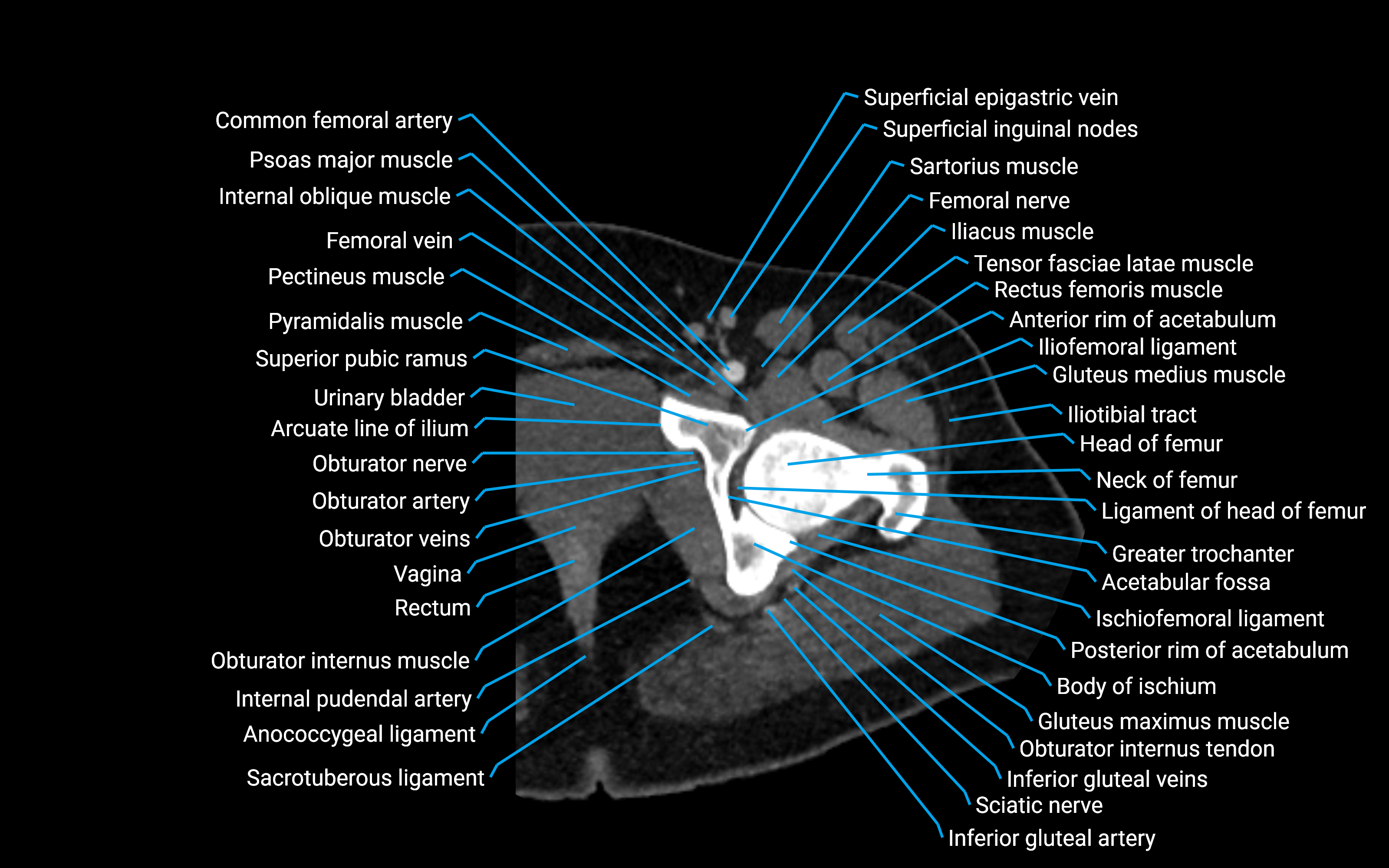 CT Hip axial cross sectional anatomy labelled image 9 (1).png